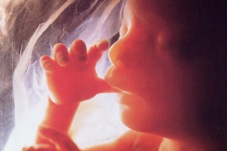 Fetus in feto, el gemelo escondido